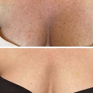 Observ Skin Analysis &ndash; Body Beautiful Retreat &ndash; Brisbane