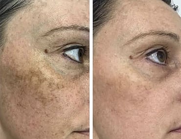 Observ Skin Analysis – Body Beautiful Retreat – Brisbane