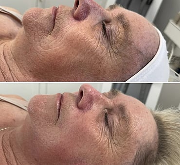 Observ Skin Analysis &ndash; Body Beautiful Retreat &ndash; Brisbane