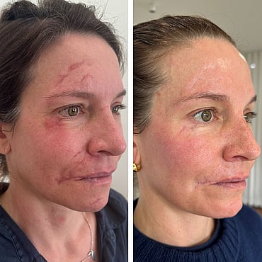 Observ Skin Analysis &ndash; Body Beautiful Retreat &ndash; Brisbane