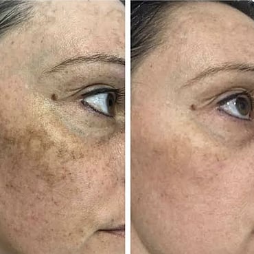 Observ Skin Analysis &ndash; Body Beautiful Retreat &ndash; Brisbane