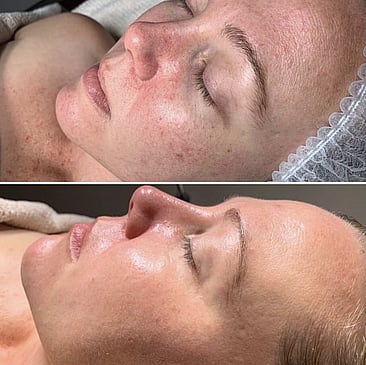 Observ Skin Analysis – Body Beautiful Retreat – Brisbane