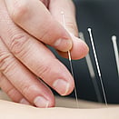 Dry needling - An excellent way to further release tight and sore muscles