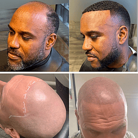 HAIR LOSS SYSTEMS