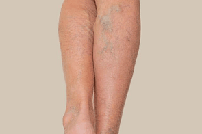 Bruising & Varicose Veins