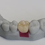 Cement retained zirconia crown on printed atlantis digital model