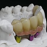 Zirconia cement retained bridge