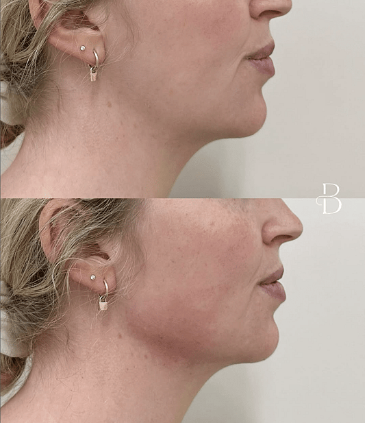 Bloom Aesthetics clients results after dermal filler in their chin