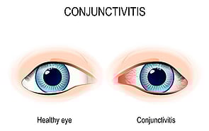Eye Infections