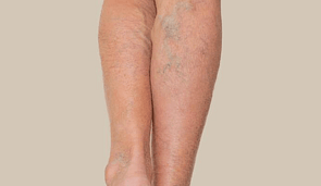 Bruising & Varicose Veins