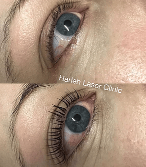 yumi lash lift Harleh Laser Clinic