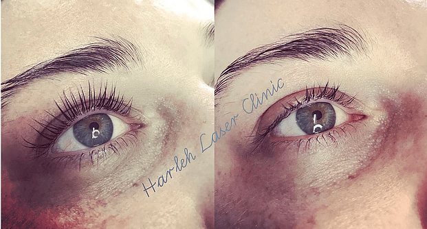 yumi lash lift Harleh Laser Clinic