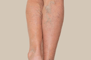 Bruising & Varicose Veins