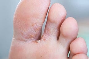 Athlete's Foot