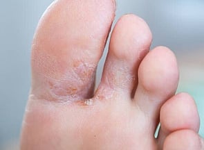 Athlete's Foot