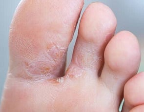 Athlete's Foot