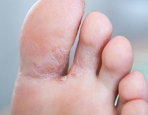 Athlete's Foot