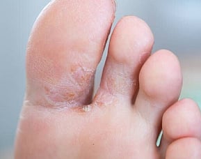 Athlete's Foot