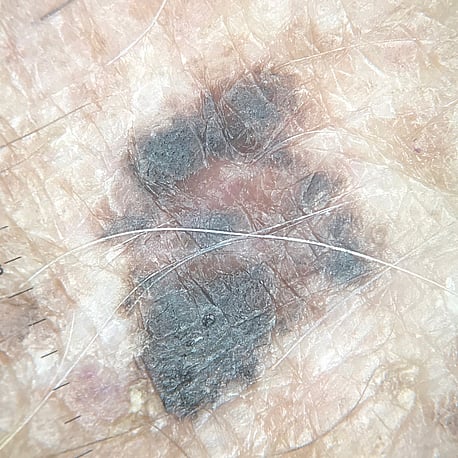 Non-polarised image &ndash; Melanoma