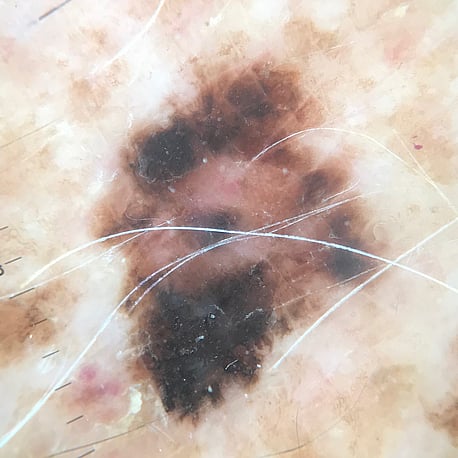 Polarised image &ndash; Melanoma