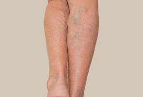 Bruising & Varicose Veins