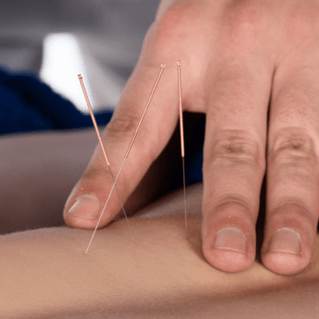 Traditional Chinese Medicine - Acupuncture