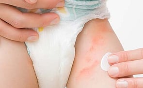 Nappy Rash