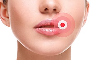 Cold Sores