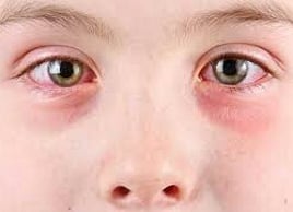 Eye Allergies