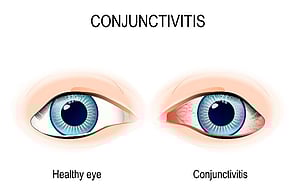 Eye Infections