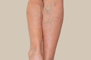 Bruising & Varicose Veins
