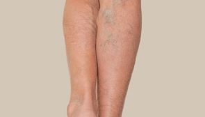 Bruising & Varicose Veins