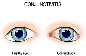 Eye Infections