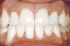 After FastBraces&reg; treatment 