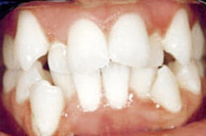 Before FastBraces&reg; treatment