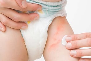 Nappy Rash
