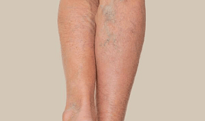 Bruising & Varicose Veins