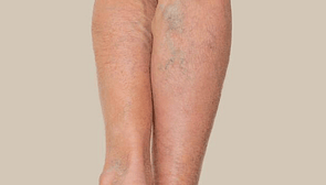 Bruising & Varicose Veins