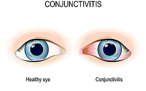 Eye Infections