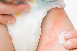 Nappy Rash