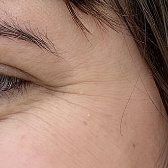 Photo of clients crows feet before anti-wrinkle treatment with Dysport at Bloom Aesthetics