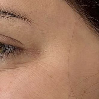 Photo of clients crows feet after anti-wrinkle treatment with Dysport at Bloom Aesthetics