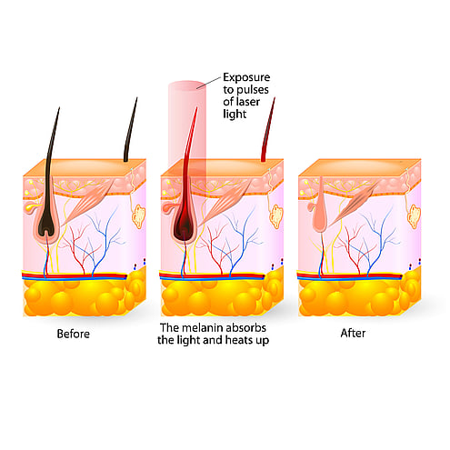 Laser Hair Removal Cambridge - how it works