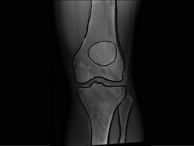 X-ray illustration of a human knee joint, showing detailed outlines of the femur, tibia, and patella, against a dark background.
