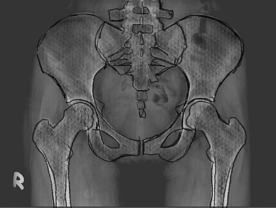 X-ray illustration of a human pelvis and hip bones, showing detailed outlines of the skeletal structure, including the femur and pelvis, against a dark background.