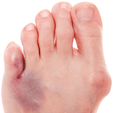 Specialist podiatry care for toe fractures and trauma with protective footwear, orthotics, and rehabilitation at Foot Foundation