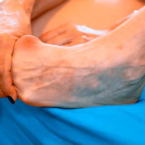 Foot Foundation podiatry treatment for stress fractures in the leg or foot with early diagnosis, orthotics, and rehabilitation support