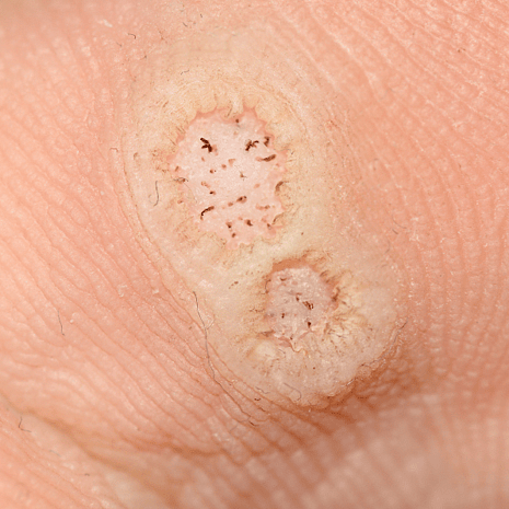 Specialist podiatry care for plantar warts with cryotherapy, needling, and photodynamic therapy at Foot Foundation