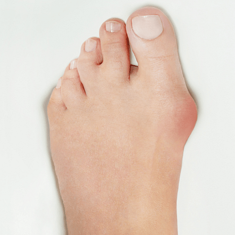 Foot Foundation podiatry treatment for bunions and hallux valgus with orthotics, footwear advice, and rehabilitation