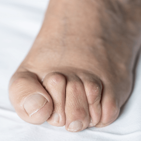 Foot Foundation podiatry care for plantar plate injuries with orthotics, taping, footwear advice, and rehabilitation